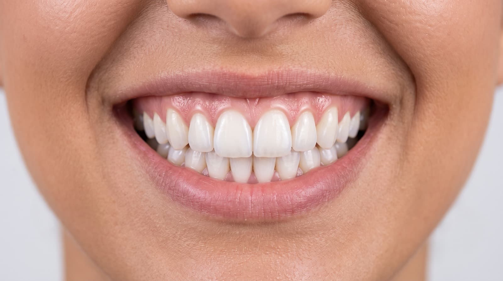 Smile Makeover