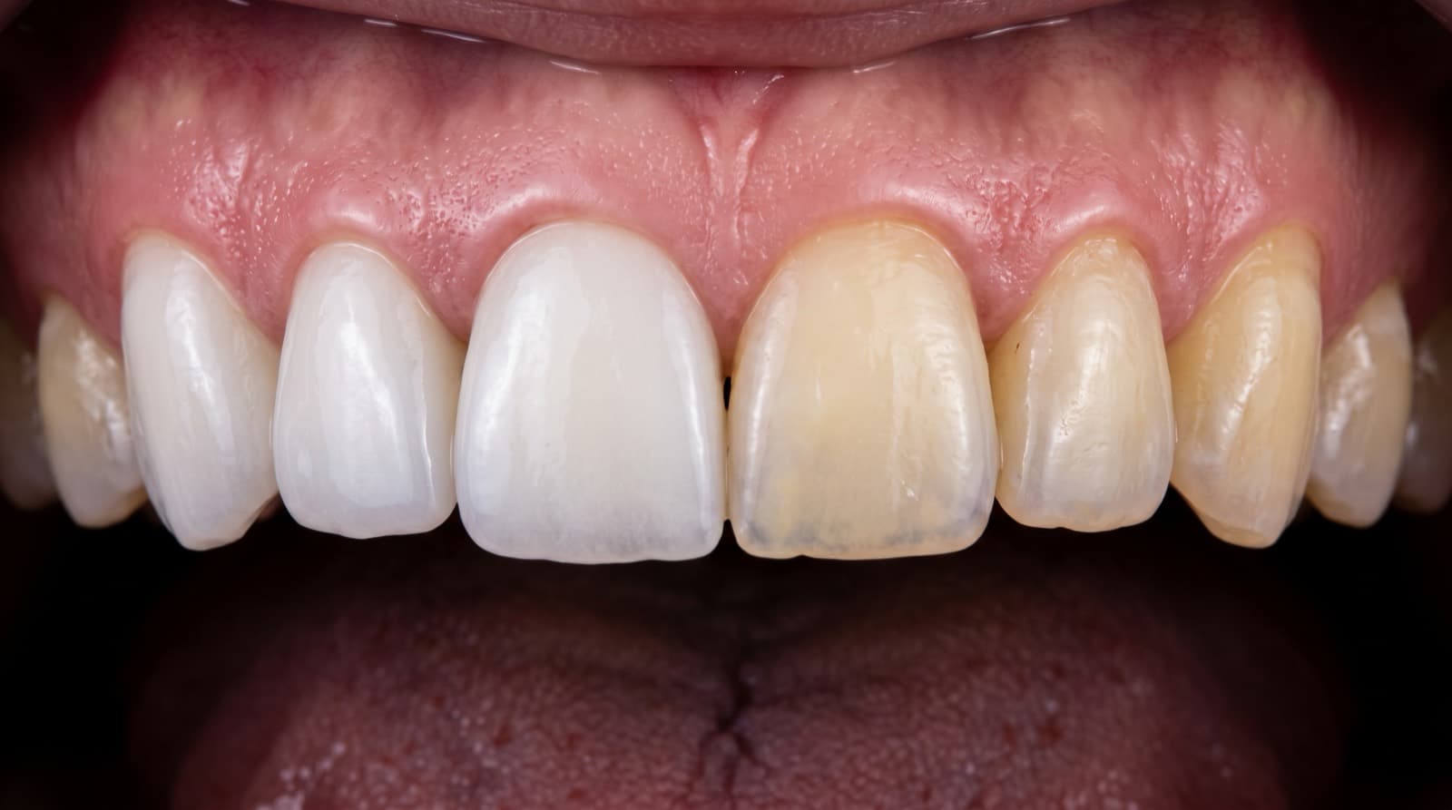 Zirconium Crowns