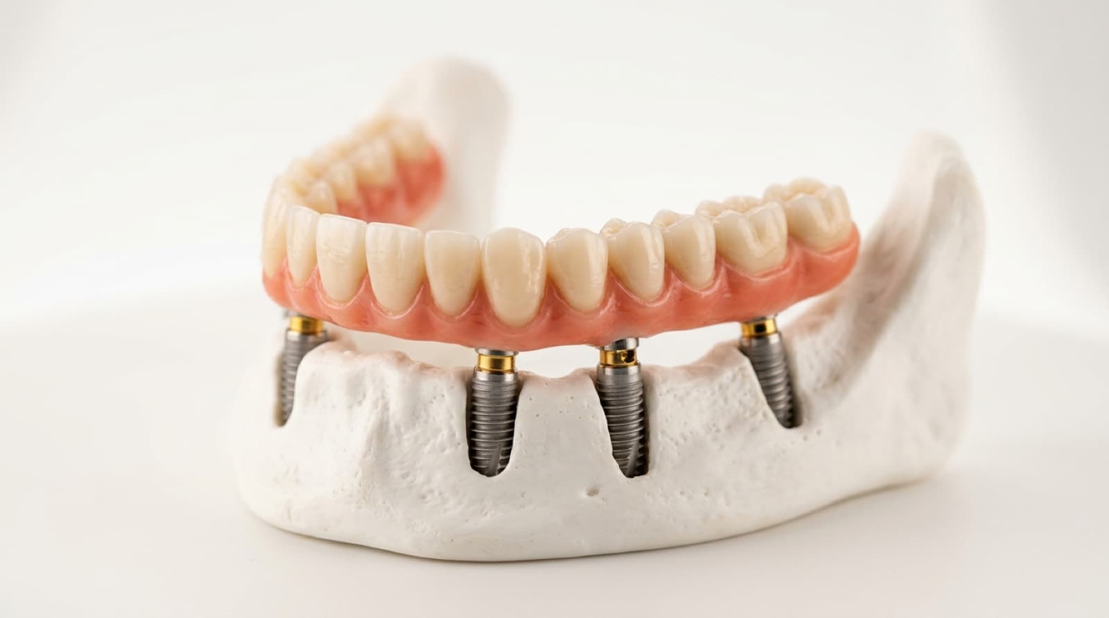 Dental Implants