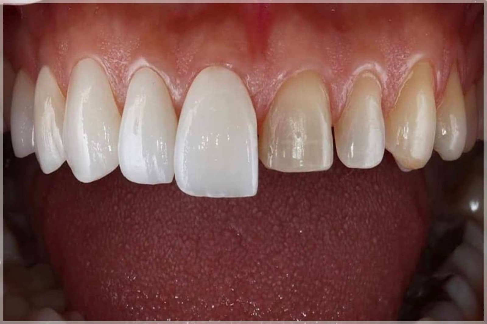 Veneers or Crowns? The Difference Nobody Explains Properly